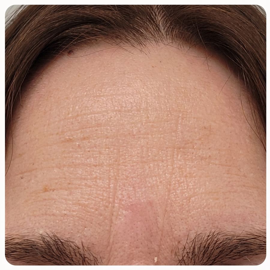 Forehead lines