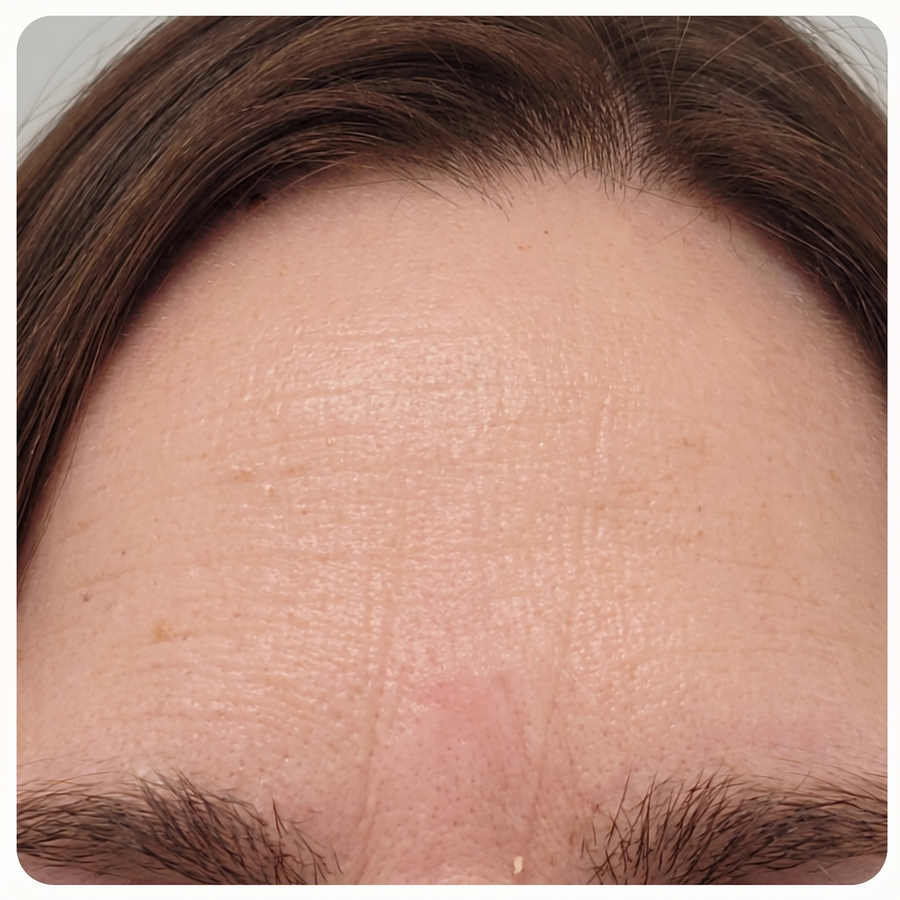 Forehead lines